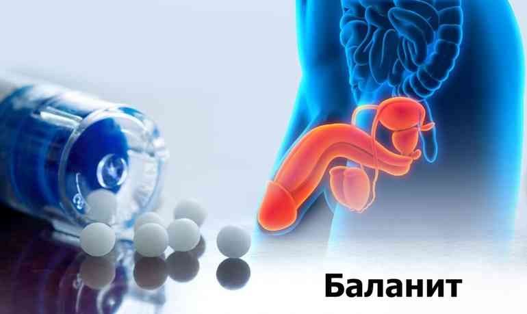 Баланит качественное лечение и профилактика