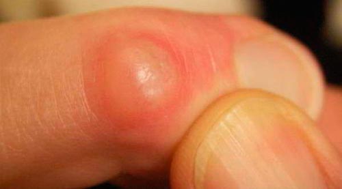 Бурсит (воспаление) суставной сумки пальцев и лучезапястного сустава кисти руки