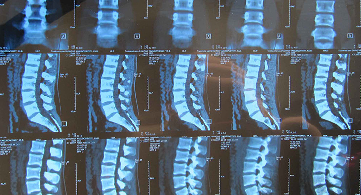 Что такое спондилез позвоночника: симптомы, лечение, профилактика