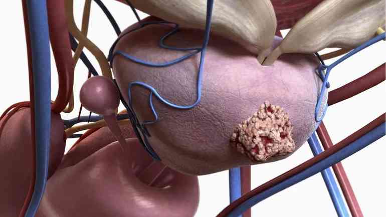 Какие существуют стадии рака простаты?