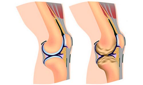 Причины артроза