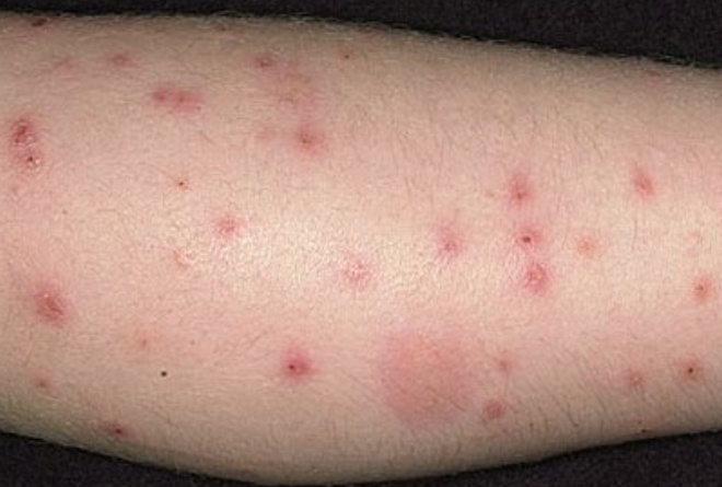 укус от клопа