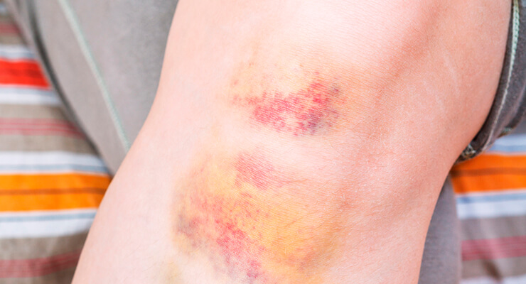 Что происходит при ушибе коленного сустава? Что происходит при ушибе коленного сустава?