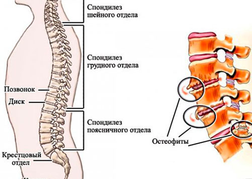 Причины и симптомы деформирующего спондилеза поясничного отдела позвоночника