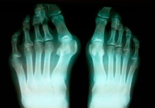 Рентген стопы