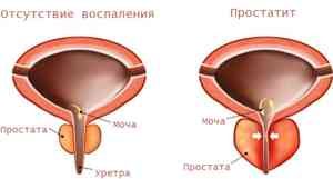 Основные признаки простатита и способы его лечения