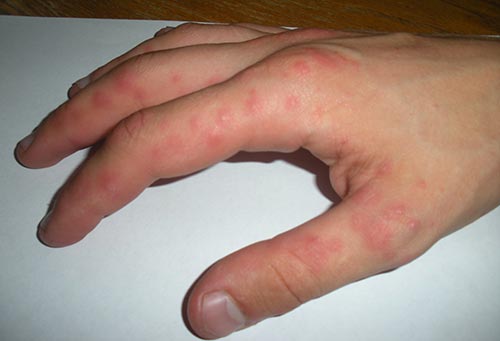 Болезнь Стилла у взрослых и детей – симптомы и лечение