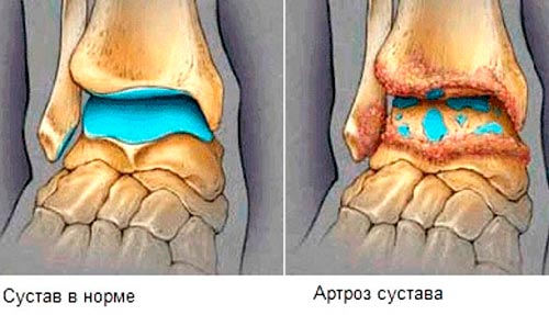 Артроз сустава