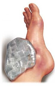 растяжение связок ноги