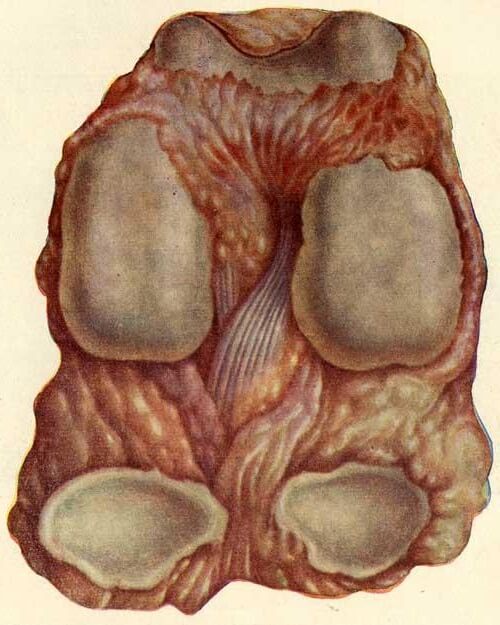 туберкулез колена