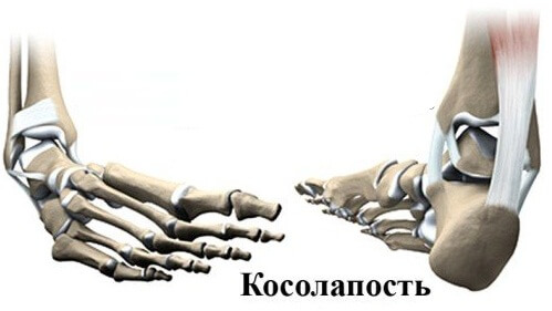 косолапость у детей