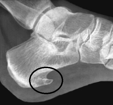 пяточная шпора