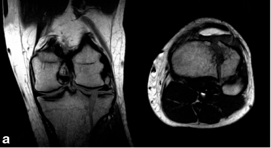 эхо картина коленного сустава
