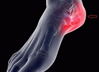 стадии артроза пятки