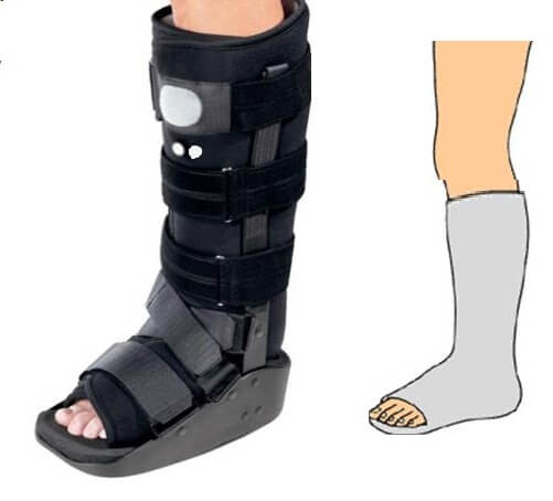 гипс при переломе