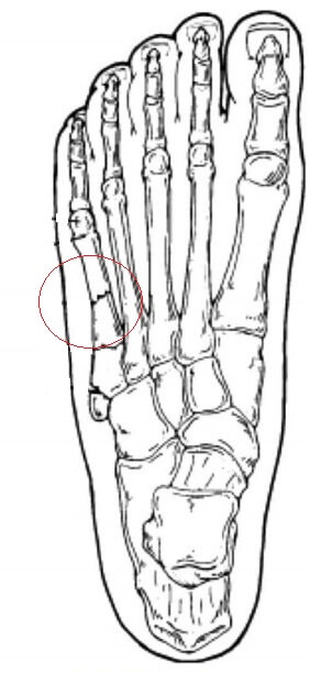 перелом пятой плюсневой