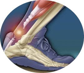 разрыв связок ноги