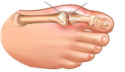 проблемы пальца ноги
