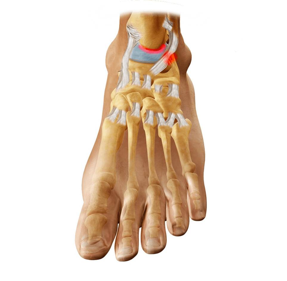 артроз голеностопа