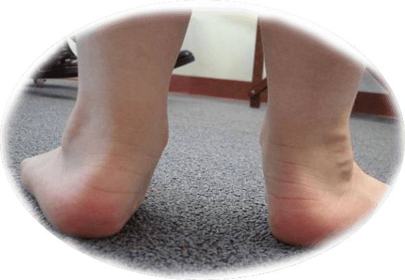 плосковальгусная стопа