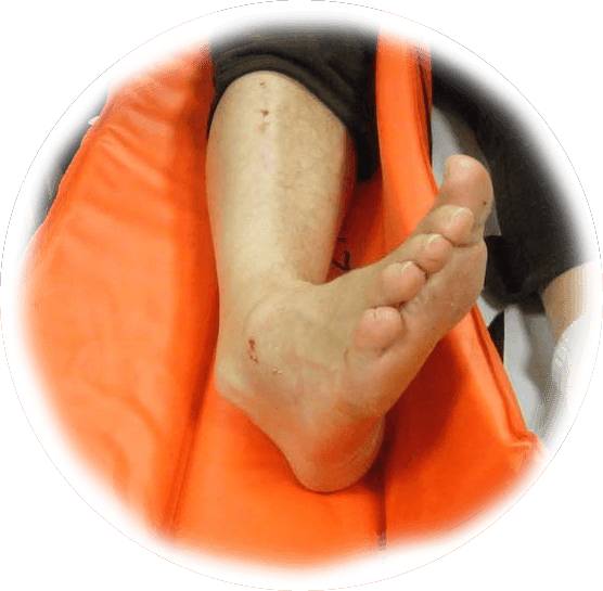 вывих голеностопа