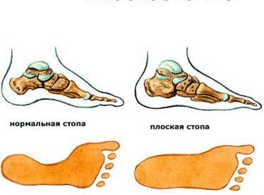 плоскостопие