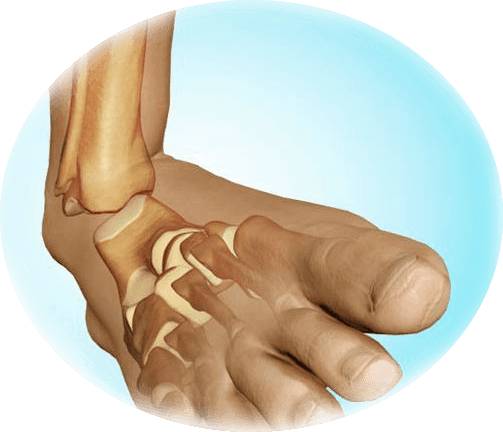 перелом голени