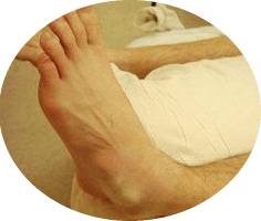 лечение вывиха голени дома