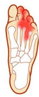 пяточная шпора