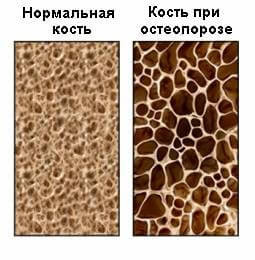 остеопароз коленного сустава