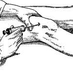 Пункция коленного сустава пункция