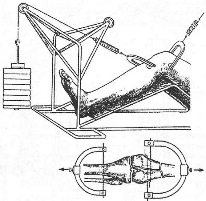 На фото изображена процедура вытяжения Вытяжение коленного сустава