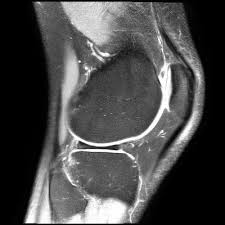 артрография мениска коленного сустава