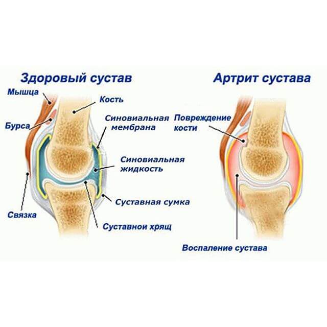 артрит может быть причиной защемления нерва артрит