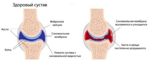 артрит причина потологии