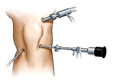 артроскопия колена