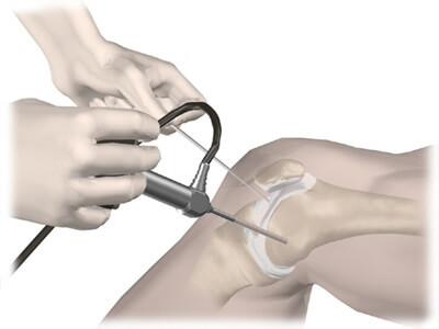 артроскопия