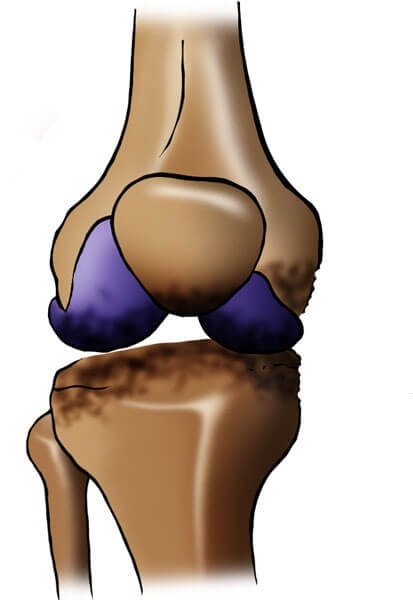 артроз сустава