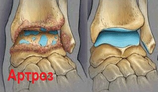 артроз голени