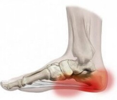 артроз пятки