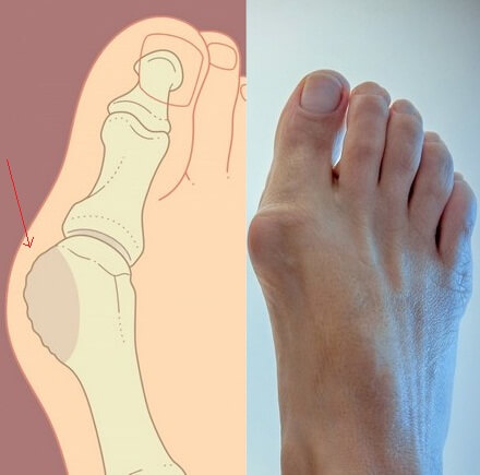 артроз пальца ноги