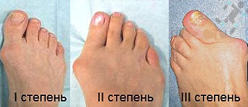 стадии развития артроза пальца