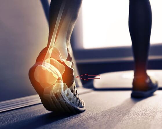 Артроз стопы