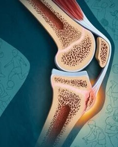 шишка на колене