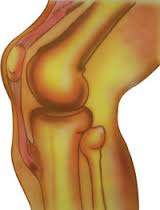 На фото болезнь Осгуда Шляттера Болезнь Осгуда Шляттера