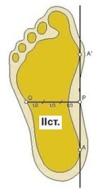 плоскостопие 2 стадия