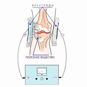 электрофорез колена