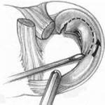 на фото изображена граница резекции мениска при горизонтальном разрыве мениск