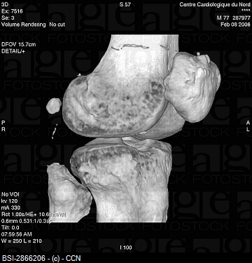 так выглядит сустав при гонартрозе гонартроз