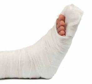 гипс при переломе ноги со смещением